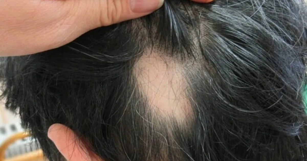 "유전이 아니었다"…탈모가 시작되는 진짜 이유와 자가 진단 방법