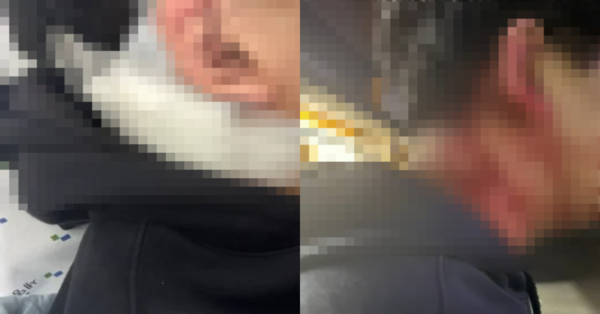 피해자 김모 씨(19)가 목덜미에 입은 상처