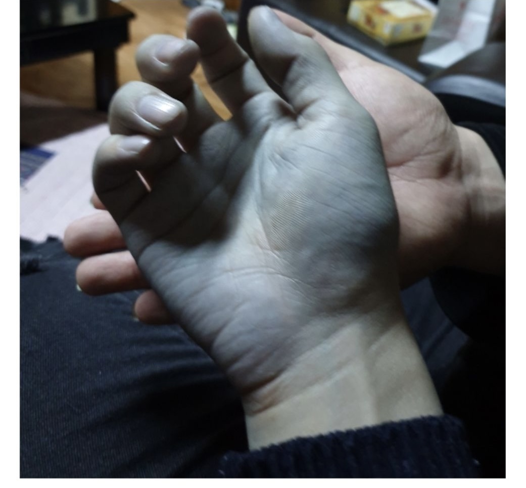 술먹고 다음날 손 변색된 남자 후기