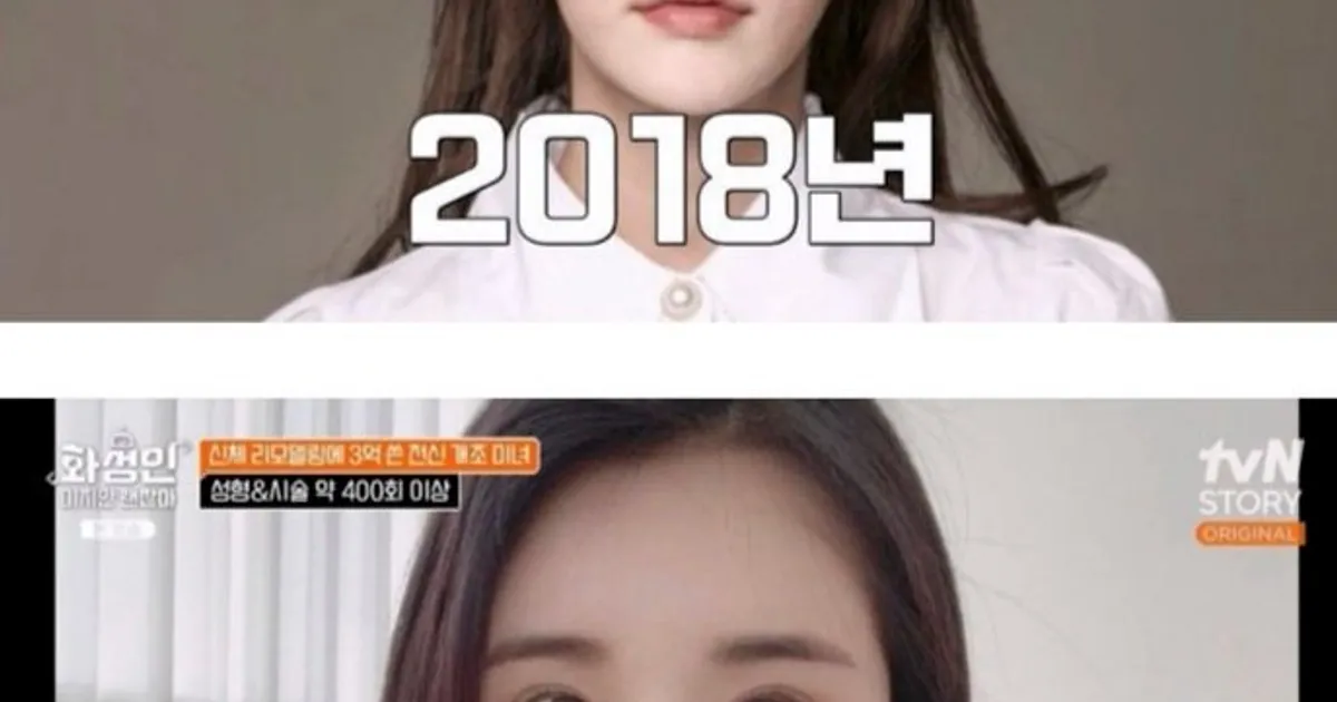 성형 수술에 3억을 썼다는 여성
