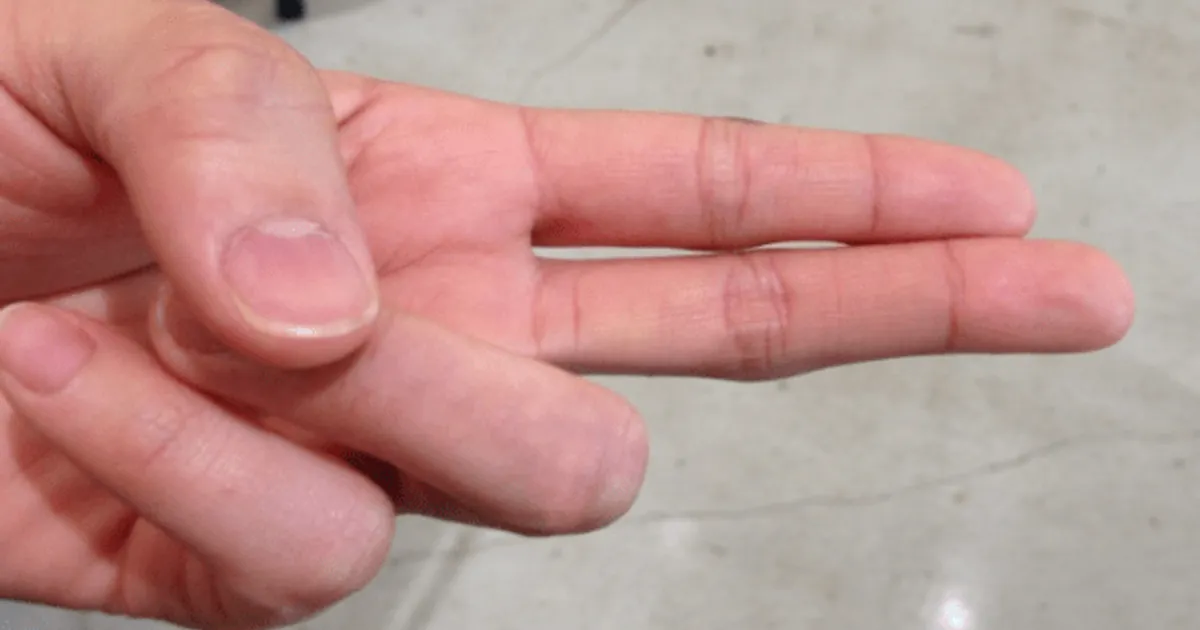 치매 찾아오면 "손가락에 이런 증상" 생깁니다, 당장 병원 가세요.