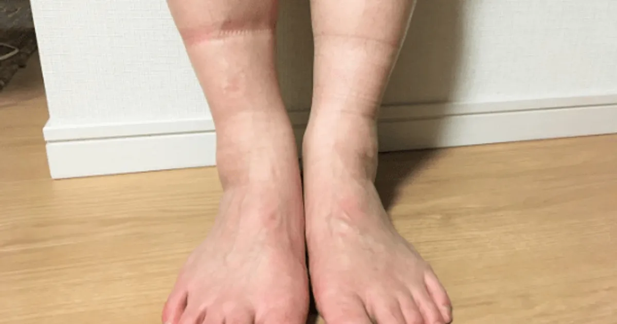 혈관이 썩기 시작하면 "다리에 이 증상"부터 찾아옵니다 당장 확인하세요.