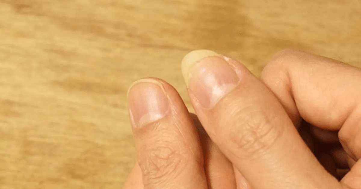 만약 손톱에 "이런 증상" 보인다면 혈액 속 단백질 전부 빠져나가는 겁니다.