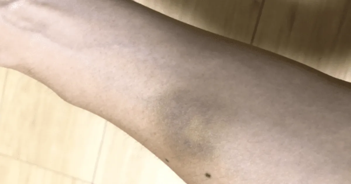 췌장암 1기가 찾아오면 "피부에 이 증상"부터 보입니다 바로 병원가세요.