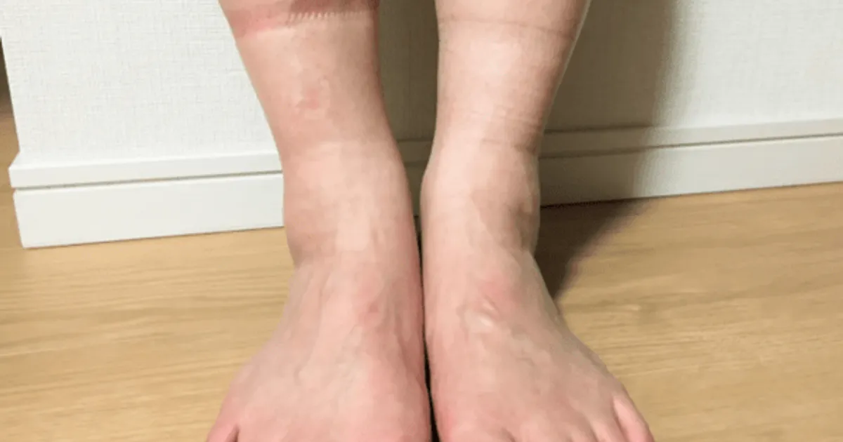 만약 종아리가 "이런 상태"라면 혈관 심각한 상태인겁니다.