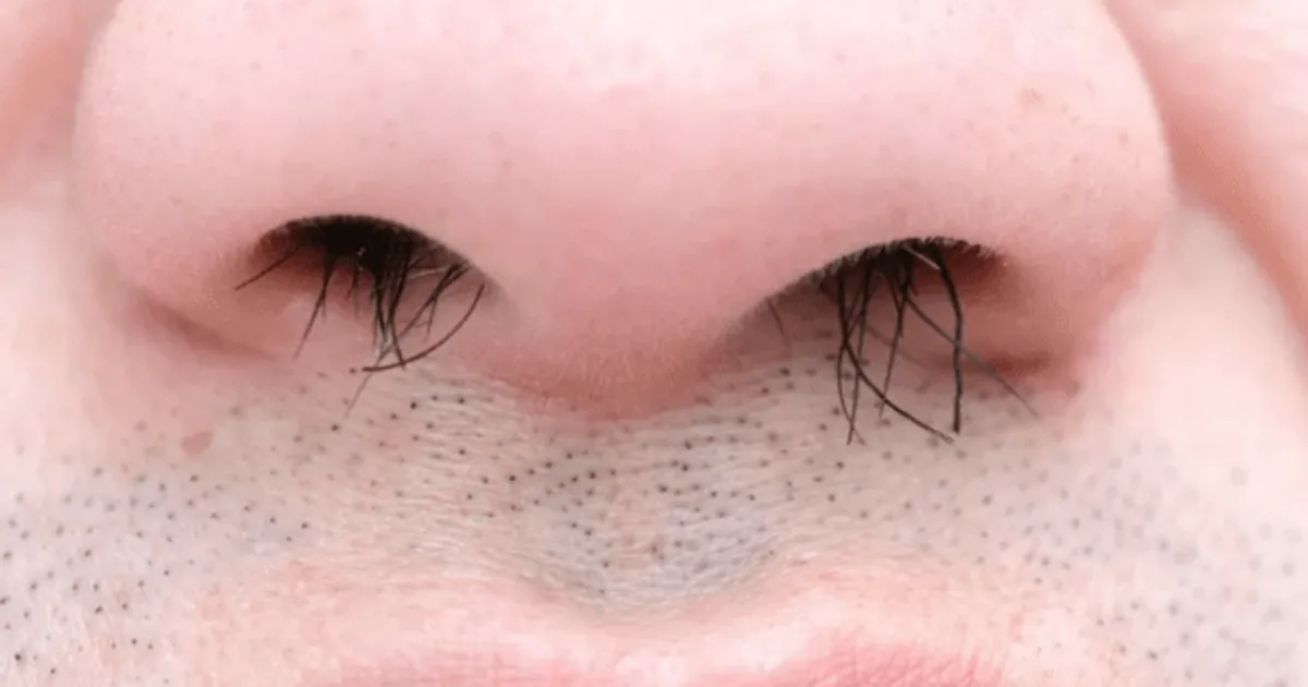 삐져나온 코털 절대 '이렇게 뽑으면' 안 됩니다. 세균이 바로 뇌까지 올라갑니다